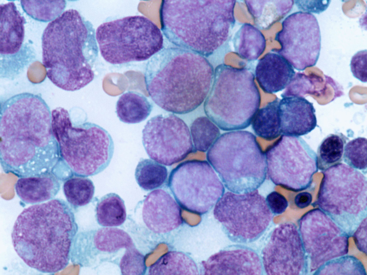 Numerous blasts showing no definitive lineage-specific features (aspirate smear, Wright-Giemsa, 100x)